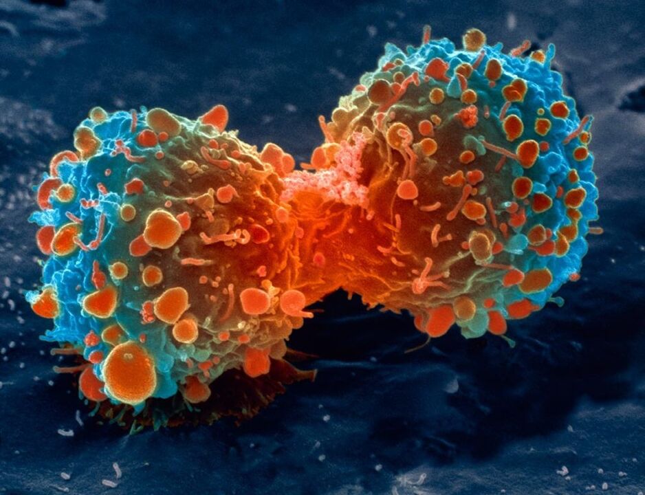 Tumorzelle als Komplikation der Prostatitis. 